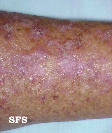 .keratosis solar Adapted from Dermatology Atlas.[1]