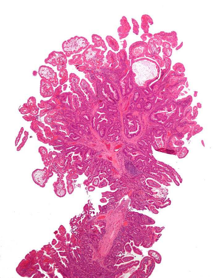 File:Peutz-Jeghers syndrome polyp.jpg