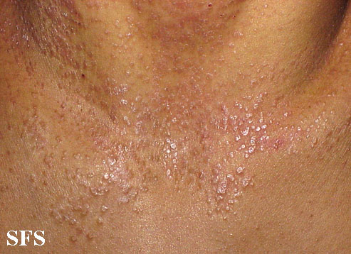 Pityriasis rubra pilaris. Adapted from Dermatology Atlas.[4]