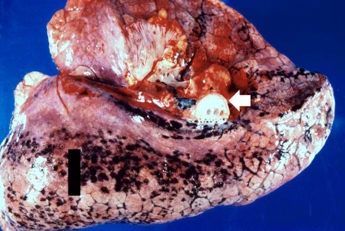 This is a gross photograph of lung demonstrating acute pulmonary congestion and edema. A frothy exudate fills the bronchus (arrow).