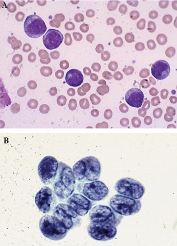Large malignant-appearing cells, with agranular cytoplasm, cleaved nuclei and prominent neocleoli on peripheral blood smear using Wright stain (A) and similar blast cells present in cerebrospinal fluid