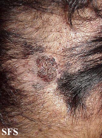 Verrucous carcinoma. Adapted from Dermatology Atlas.[10]
