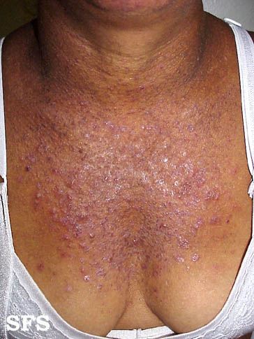 Darier's disease. Adapted from Dermatology Atlas.<ref name="Dermatology