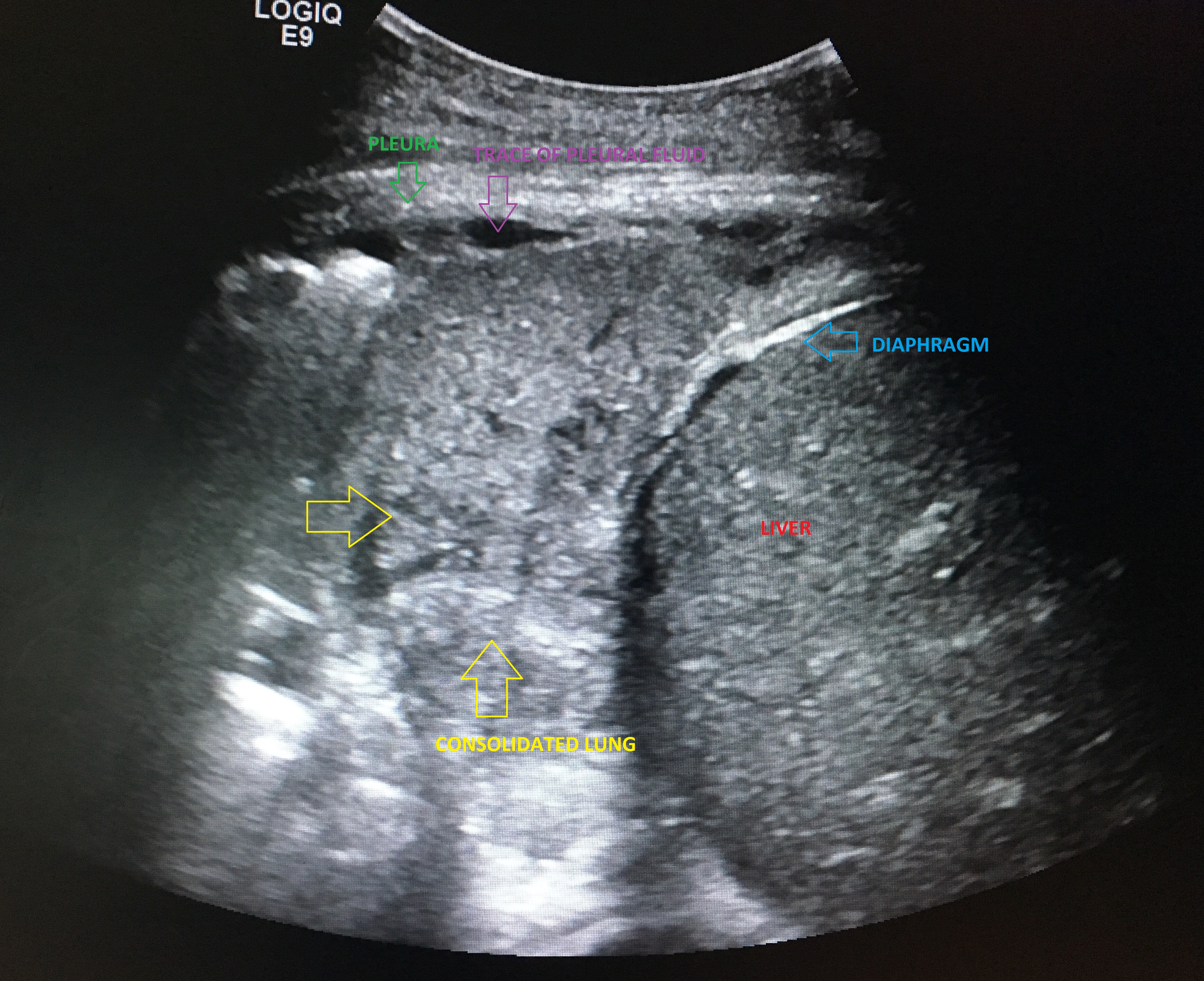 File:Lung-consolidation-on-ultrasound.jpeg