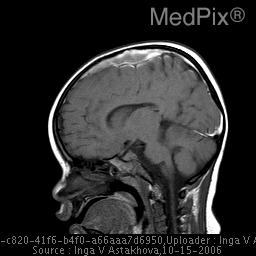 File:MRI Subdural Hematoma T1.jpg