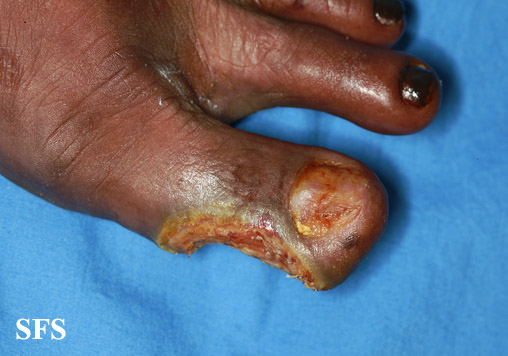 Peripheral occlusive arterial disease. Adapted from Dermatology Atlas.[1]