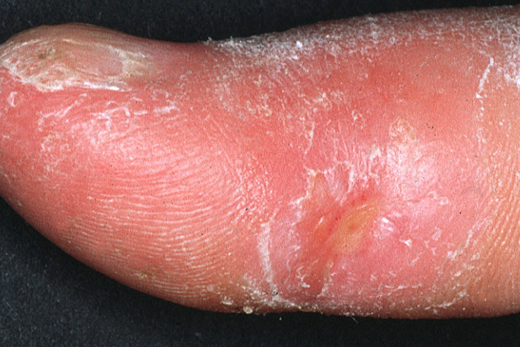 Clinical appearance of acrosclerotic piece-meal necrosis of the thumb in a patient with systemic sclerosis Source:Images courtesy of Professor Peter Anderson DVM PhD and published with permission © PEIR, University of Alabama at Birmingham, Department of Pathology [11]