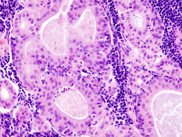 Histopathology of Warthin tumor in the parotid gland. H&E stain Source:<ref name File:Papillary cystadenoma lymphomatosum labelled.jpg Papillary_cystadenoma_lymphomatosum zones - By Jpogi - ‘’here’’). </ref>