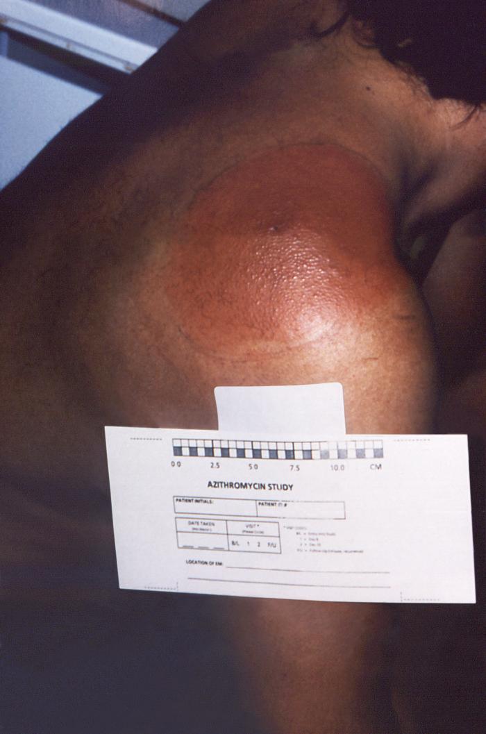 Right posterior shoulder region of a patient who’d presented with the erythema migrans (EM) rash characteristic of what was diagnosed as Lyme disease, caused by Borrelia burgdorferi. From Public Health Image Library (PHIL). [2]