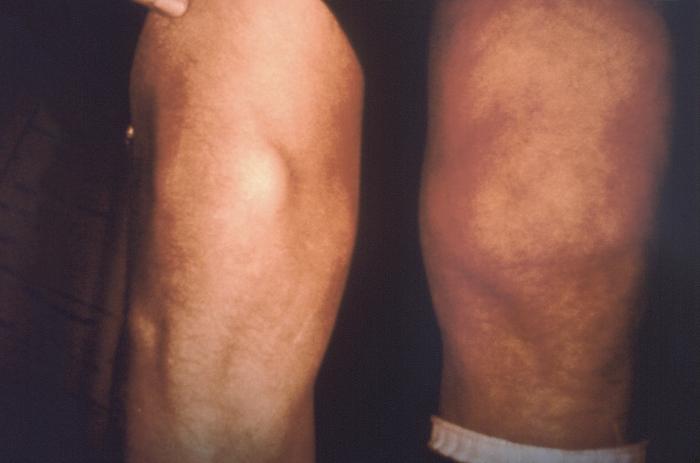 This Lyme disease patient presented with the signs and symptoms indicative of arthritic changes to his right knee due to a Borrelia burgdorferi bacterial infection. From Public Health Image Library (PHIL). [2]