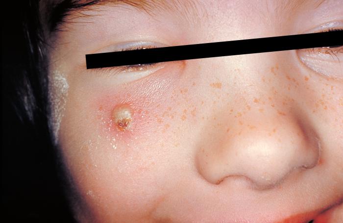 Girl with a secondary skin infection due to chickenpox