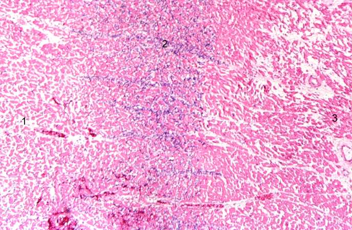 This is a photomicrograph of the edge of the infarct with normal tissue on the left (1). The accumulation of inflammatory cells (2) is at the edge of the infarcted tissue (3).