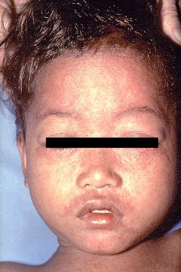 File:Measles 1.jpg