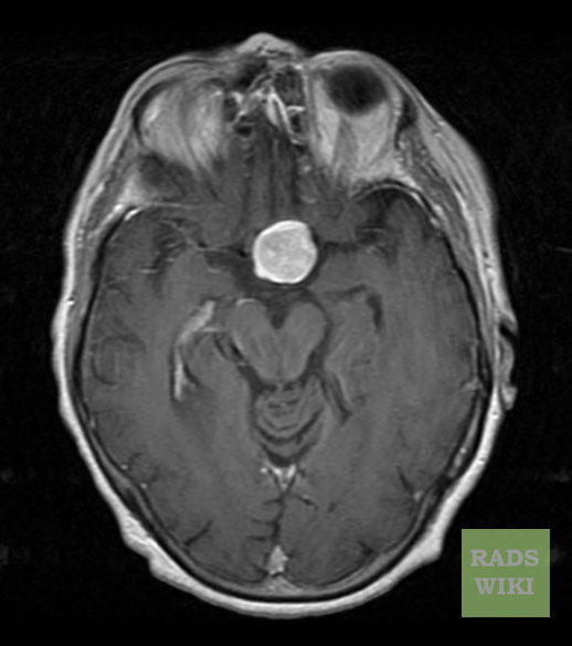 There is a well defined round lesion noted in the pituitary fossa, the lesion shows homogeneous contrast enhancement.[8]