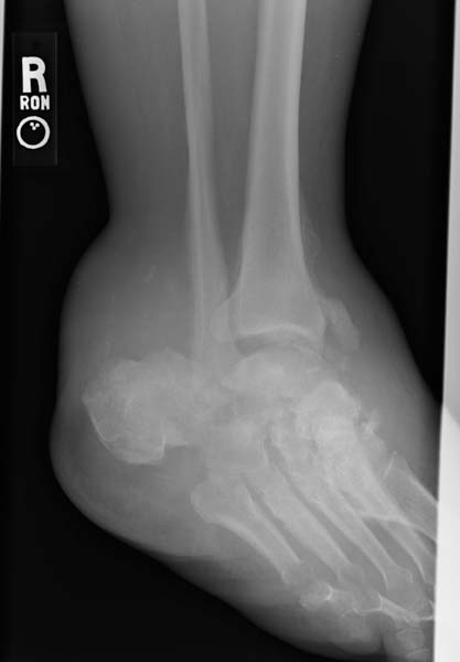File:Charcot-joint-002.jpg