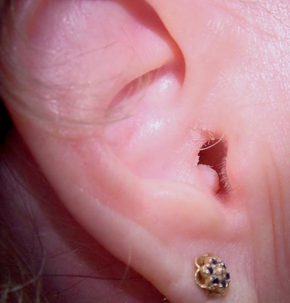 Epidermal cyst of the external auditory meatus.[1]