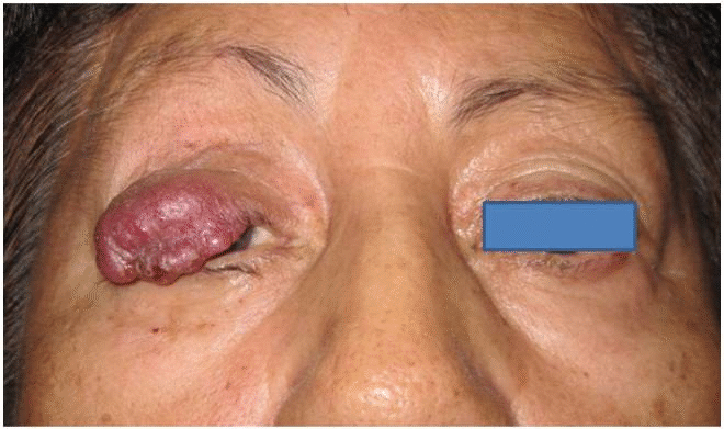 File:Merkel cell carcinoma of upper eyelid.gif