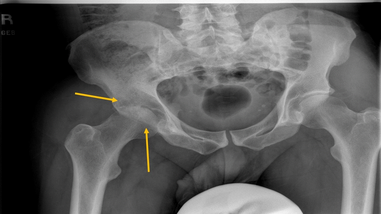 File:Septic arthritis of right hip x-ray.gif