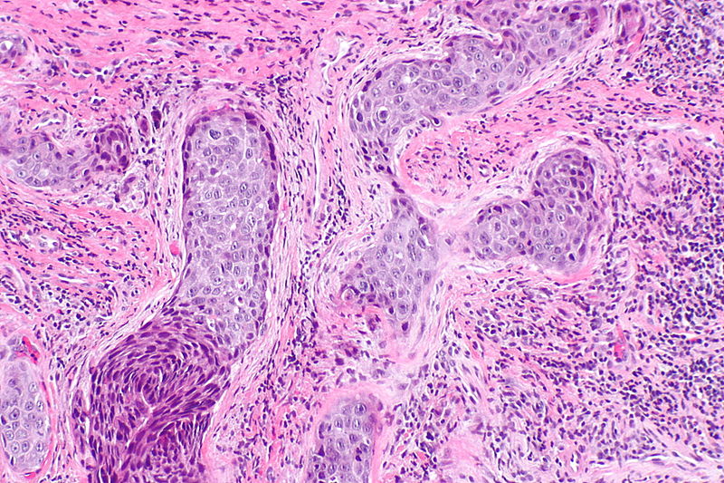 Laryngeal squamous carcinoma (Intermediate Magnification)<ref=aaa> Head and neck SCC Librepathology. http://librepathology.org/wiki/index.php/Squamous_cell_carcinoma_of_the_head_and_neck Accessed on October 26, 2015</ref>