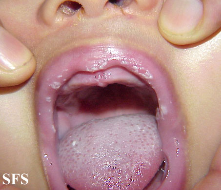 Candidiasis. Adapted from Dermatology Atlas.[2]