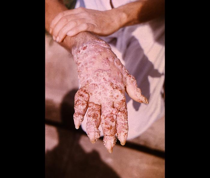 Pathologic changes in a Brazilian patient’s right hand after having been infected by what was determined to be Phialophora verrucosa fungal organisms. From Public Health Image Library (PHIL). [2]