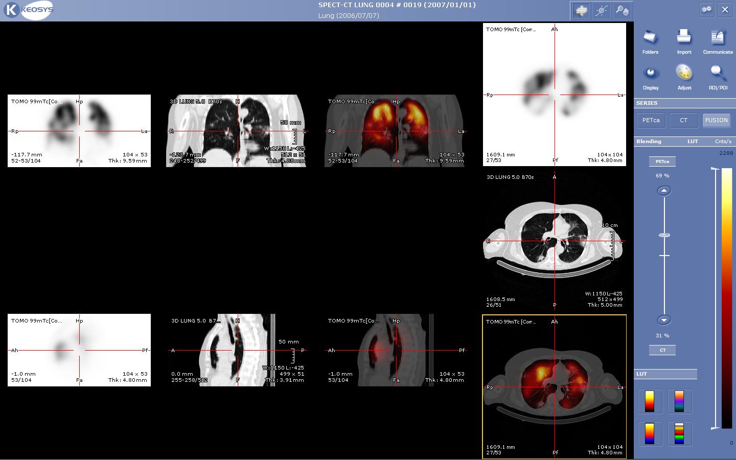 A Lung SPECT / CT Fusion image