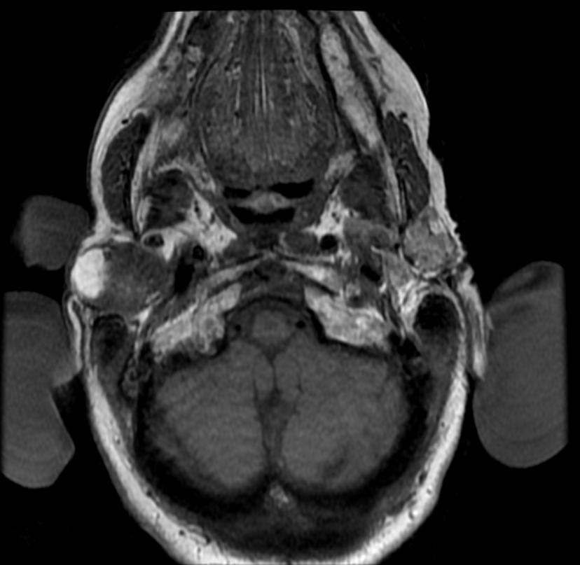 File:Pleomorphic adenoma MRI 101.jpg