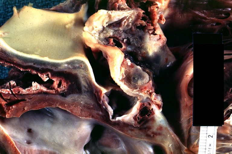 Sinus of Valsalva Aneurysm: Gross; an excellent picture; cut through aneurysm.