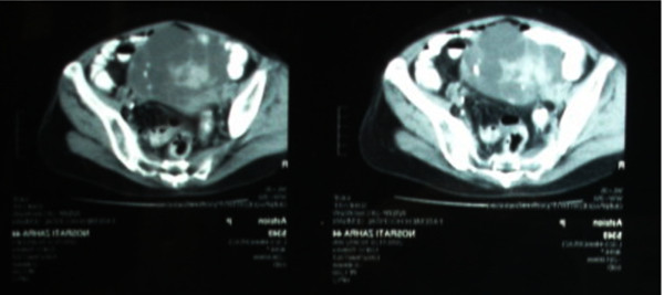 File:Struma ovarii Pelvic CT scan.jpg