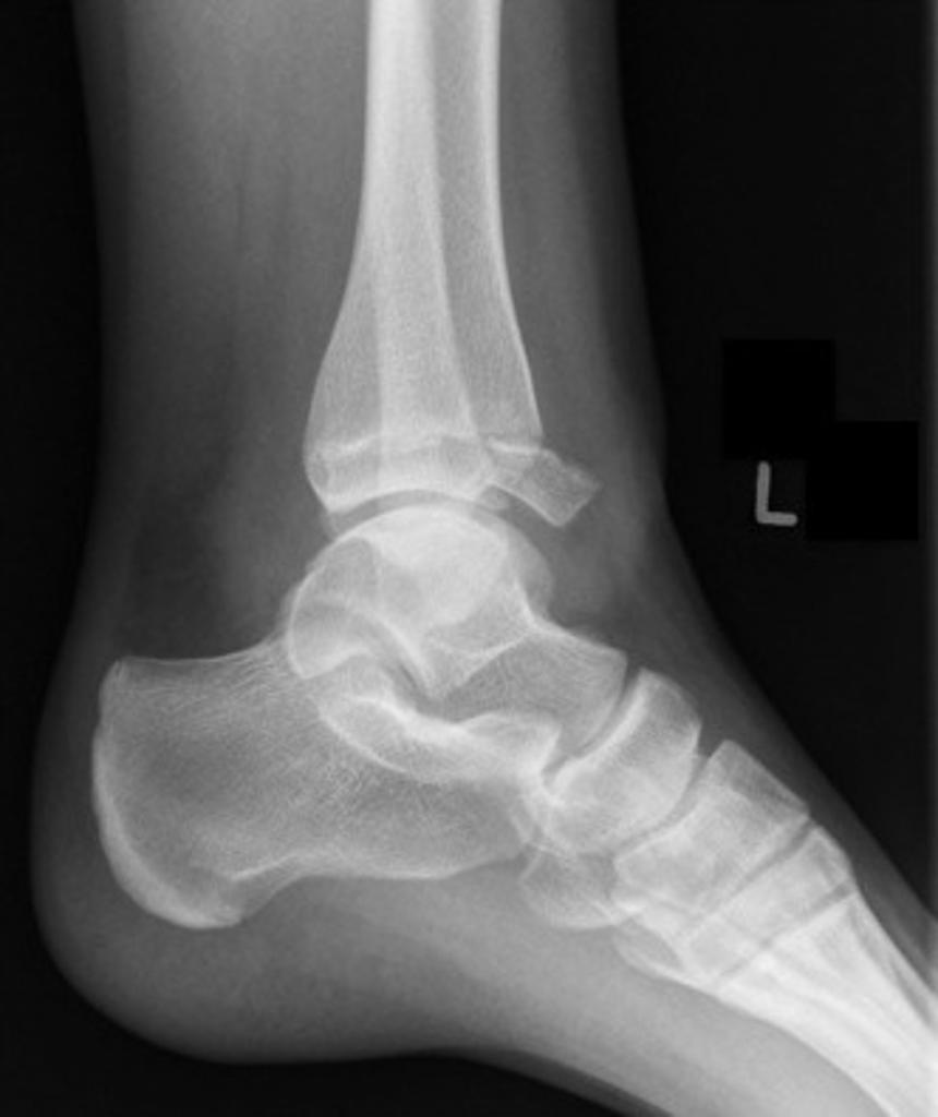 Mortis and lateral views of the left ankle demonstrate a displaced Salter Harris type III fracture of the anterolateral distal tibial epiphysis synonymous with "juvenile Tillaux fracture".