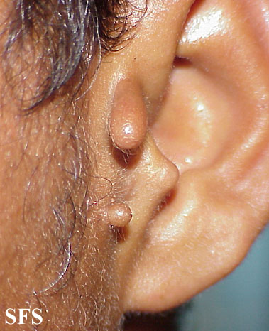 Accessory tragus. Adapted from Dermatology Atlas.[12]