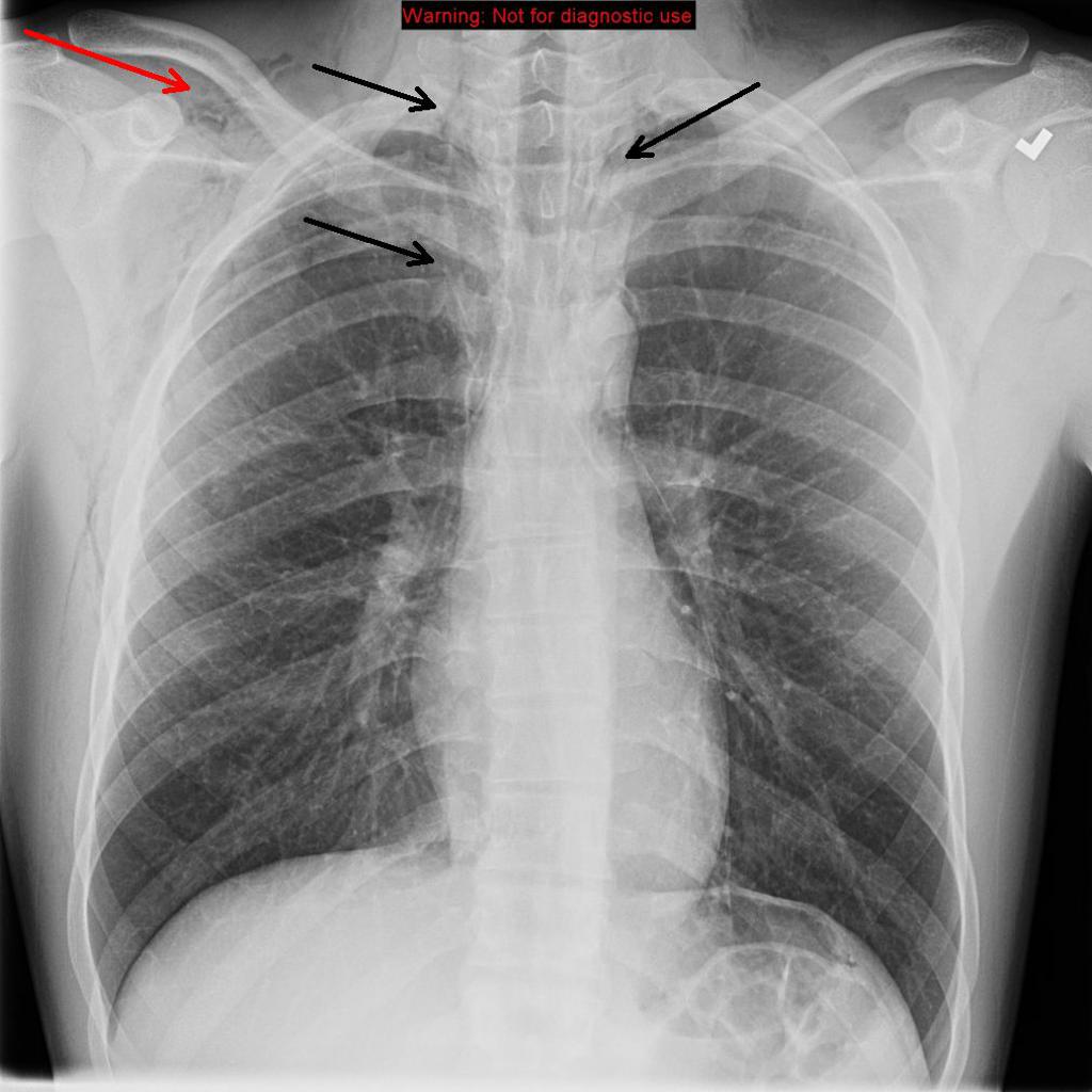 Chest X-ray: Frontal view reveals pneumomediastinum (black arrows). Subcutaneous emphysema (red arrow) along the chest wall, more prominent along the right than left; Source- Radiopaedia