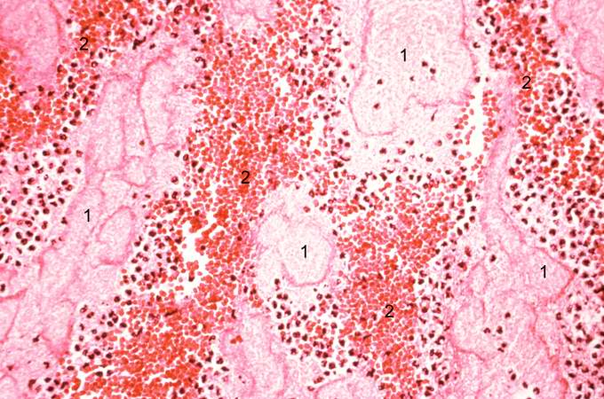 This high-power photomicrograph of thrombus demonstrates more clearly the components of the layers--the pale regions which contain primarily platelets (degranulated platelets) with some fibrin (1), and the red areas which contain RBCs, some leukocytes, and fibrin (2).