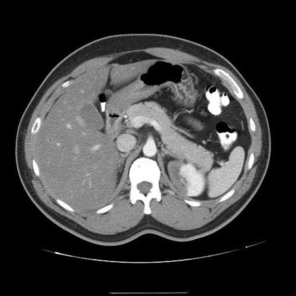 CT demonstrates a left renal infarction patient#1 Image courtesy of RadsWiki and copylefted