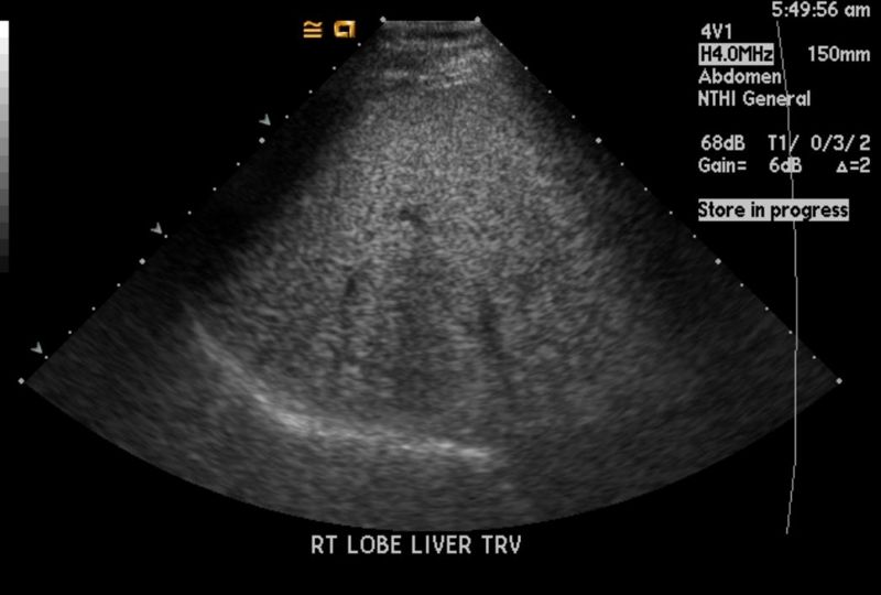 File:Fatty infiltration of liver ultrasound 101.jpg