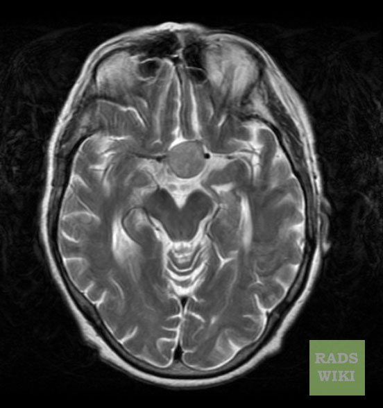 There is a well defined round lesion noted in the pituitary fossa, the lesion is homogeneous and isodense on T2.[5]