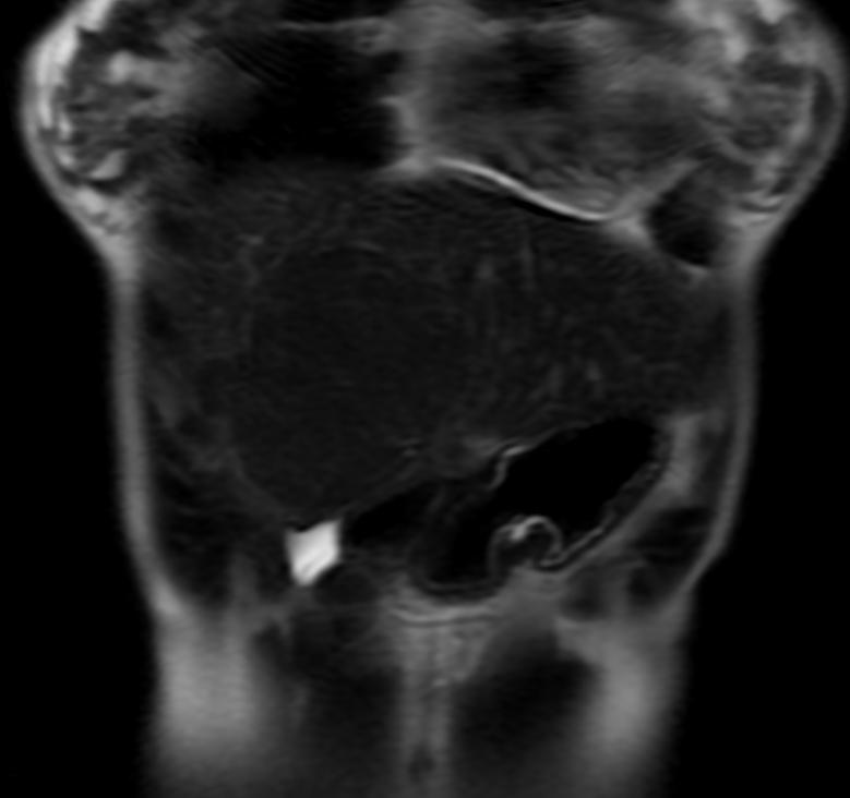 File:Hepatic ademona MRI 003.jpg