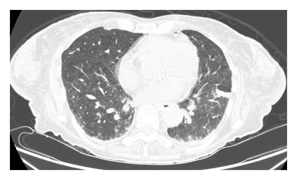 File:Intravascular large B-cell lymphoma CT .jpg