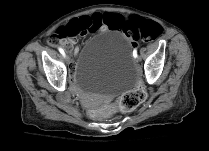 File:Sciatic hernia CT 002.jpg