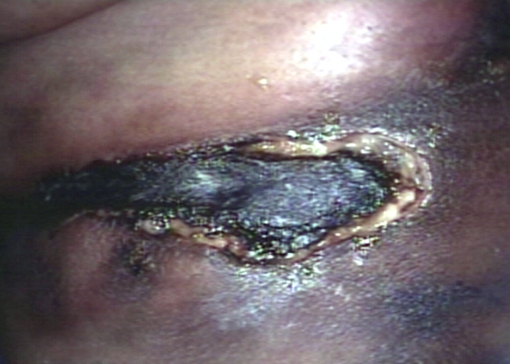 Skin: ulcer, necrotic; lupus anticoagulant in thigh. Image courtesy of Professor Peter Anderson DVM PhD and published with permission © PEIR, University of Alabama at Birmingham, Department of Pathology.[29]