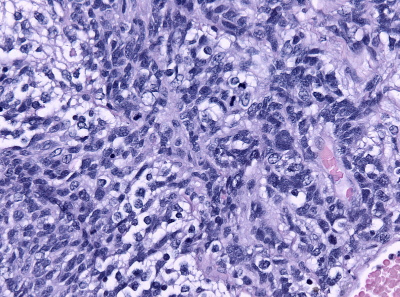 Anaplastic large cell medulloblastoma[2]