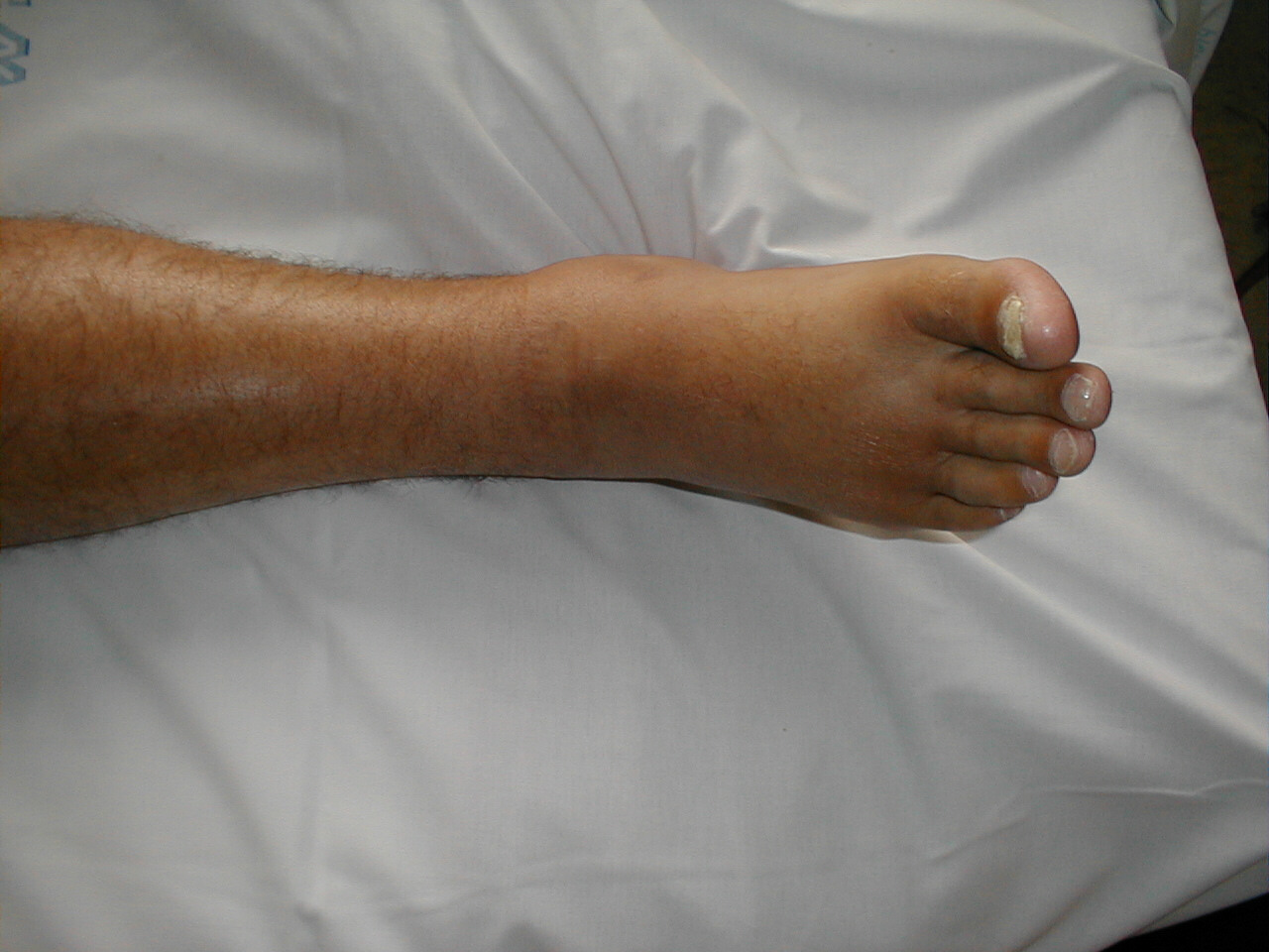 Edema of Right Foot