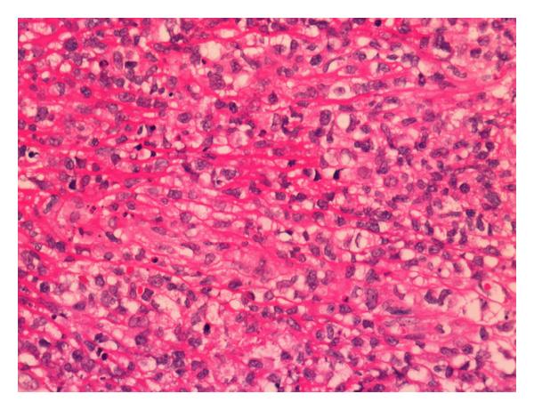 File:Extranodal NK-T cell lymphoma.jpg