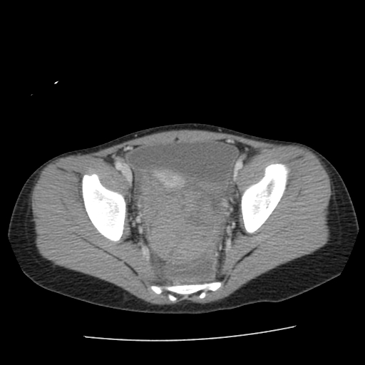 8 y/o female with right lower quadrant pain patient#2 Image courtesy of RadsWiki and copylefted