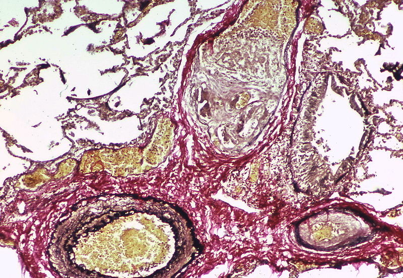 A dilatation lesion is seen in the left lower quadrant adjacent to the angiomatoid lesion. There is an elastic stain.