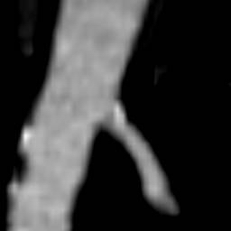 File:Renal artery stenosis 036.jpg