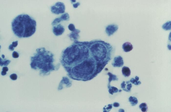 Tzanck test involving a tissue scraping of an active skin ulcer from a penile lesion, diagnosed as a case of herpes progenitalis. From Public Health Image Library (PHIL). [10]