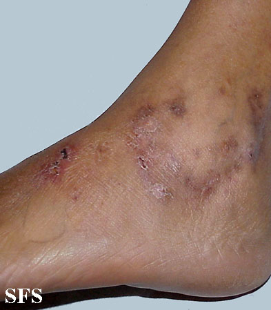 File:Vasculitis leukocytoclasia 06.jpeg