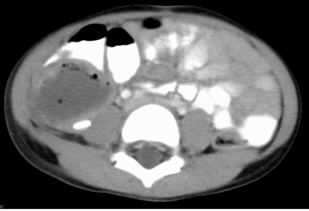 CT of abdomen showing an abscess in the retrocaecal location with an adjacent appendicolith with ascending colon being displaced anteriorly.