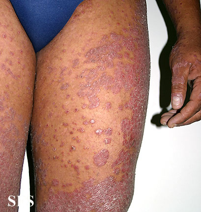 Pityriasis rubra pilaris. With permission from Dermatology Atlas.[4]